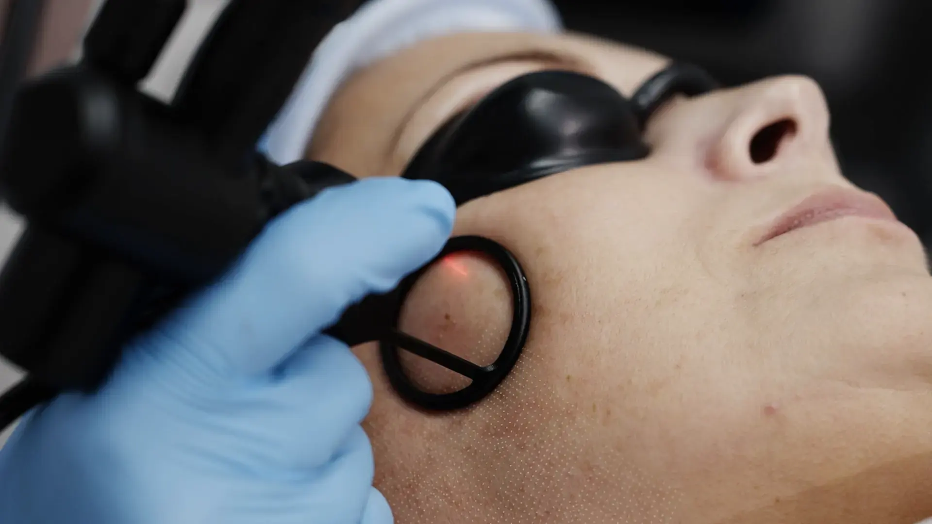 A client wearing protective eye shields has a CO2 laser handpiece held against their cheek