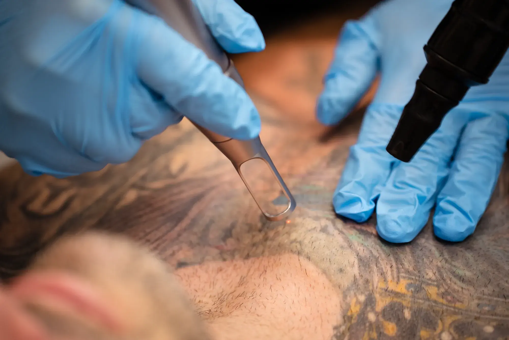 A gloved hand holds a laser handpiece against a tattooed shoulder