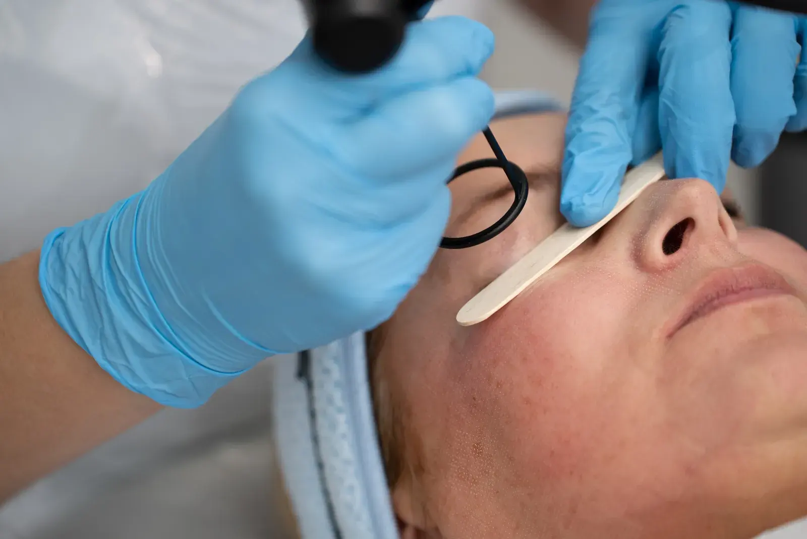 A CO2 laser handpiece held close to a client's cheek while a spatula shields the eye