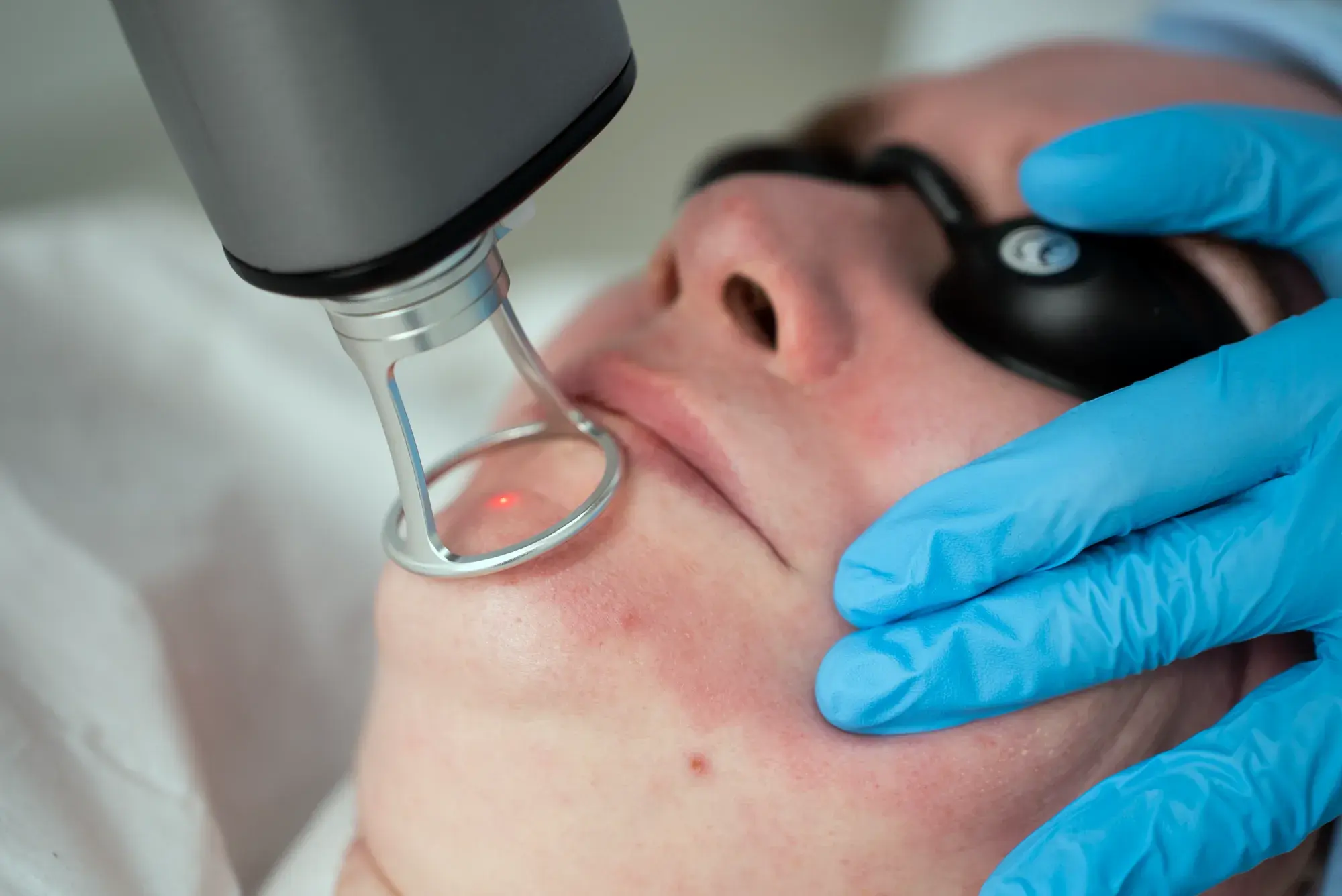 A laser handpiece with a red guide light held against a client's cheek