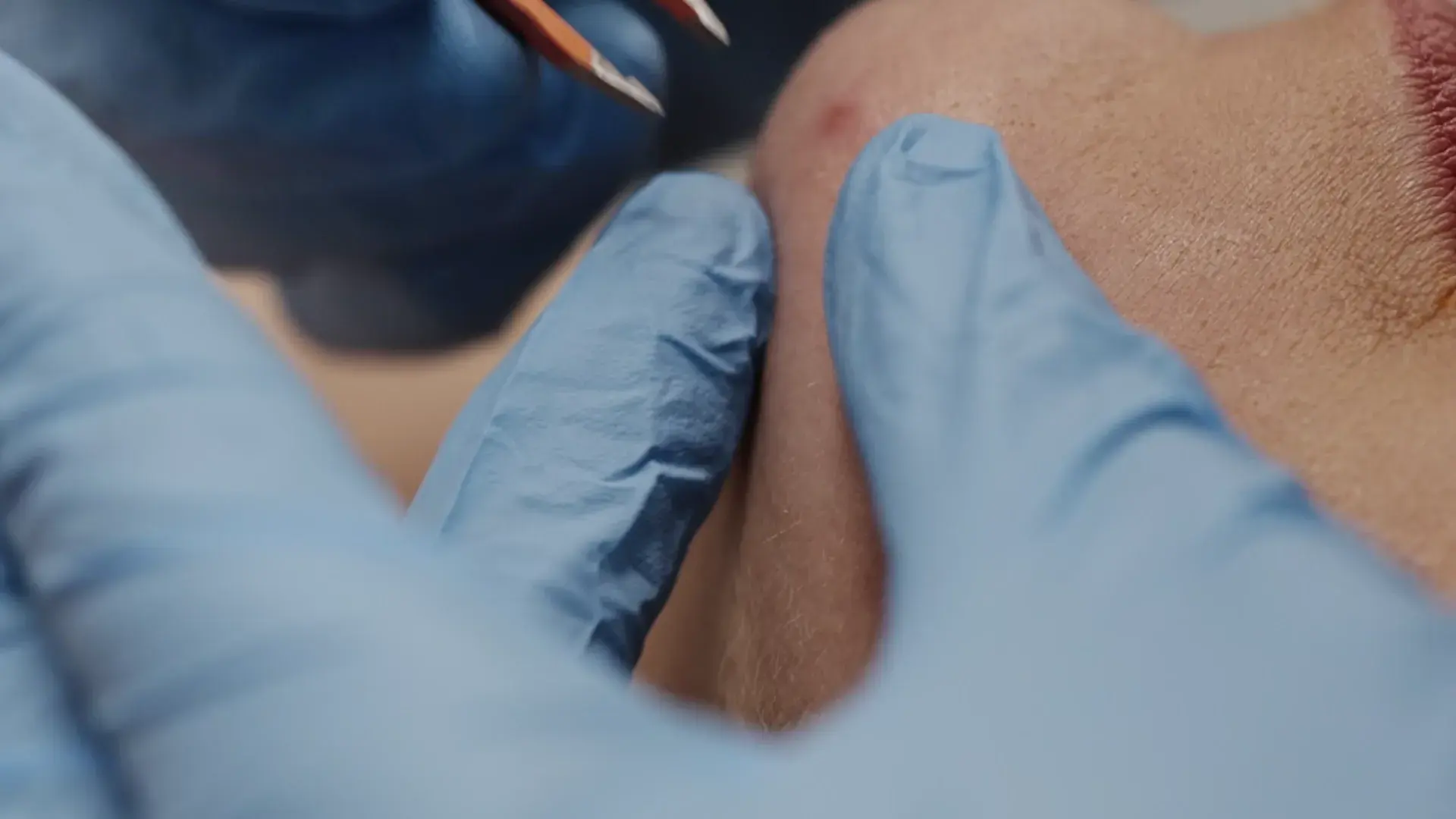 Gloved fingers hold a fine probe against a client's chin