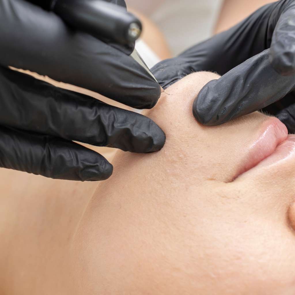 Electroylsis Lancaster