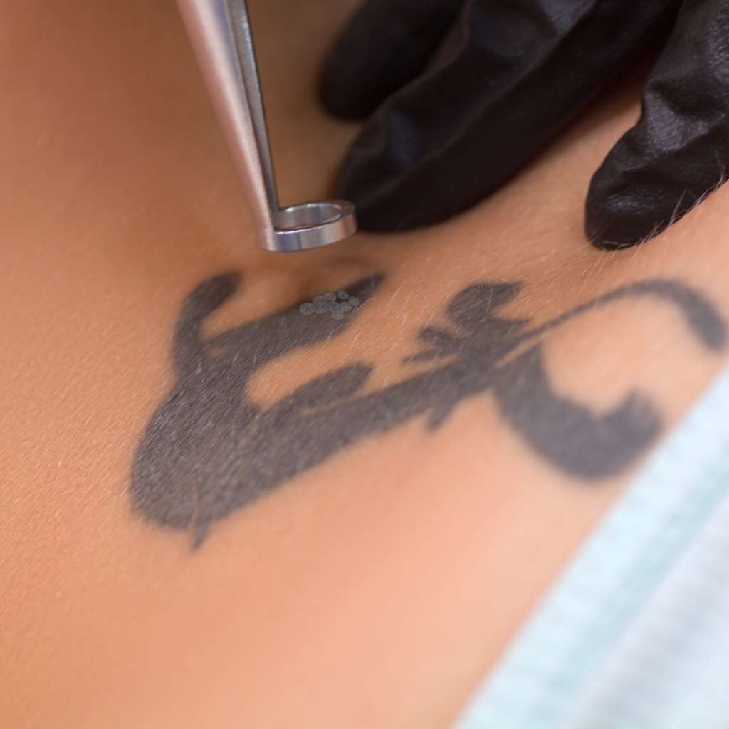 laser tattoo removal lancaster